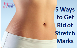 Ways to Get Rid of Stretch Marks